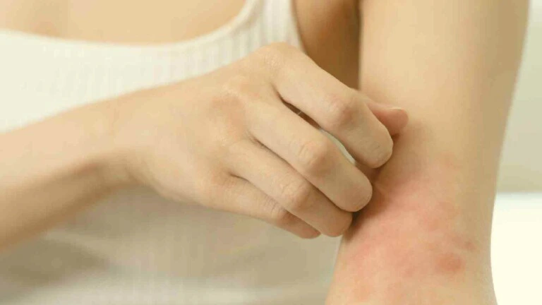 Heat Rash Ayurvedic treatment